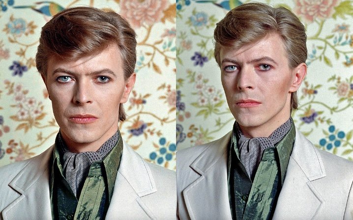 David Bowie in upclose photos showing his anisocoria eye problem