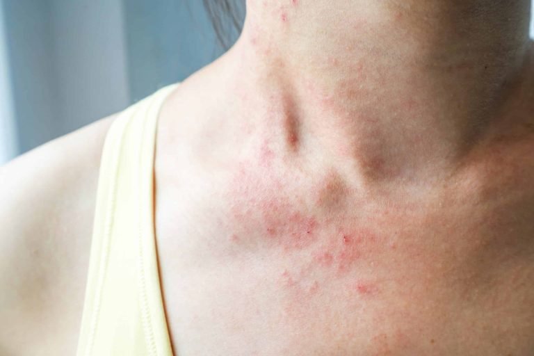 Read more about the article Nutrafol Skin Rash: Causes, Experiences, and Alternatives