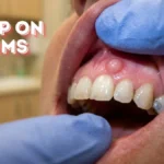 bump on gums