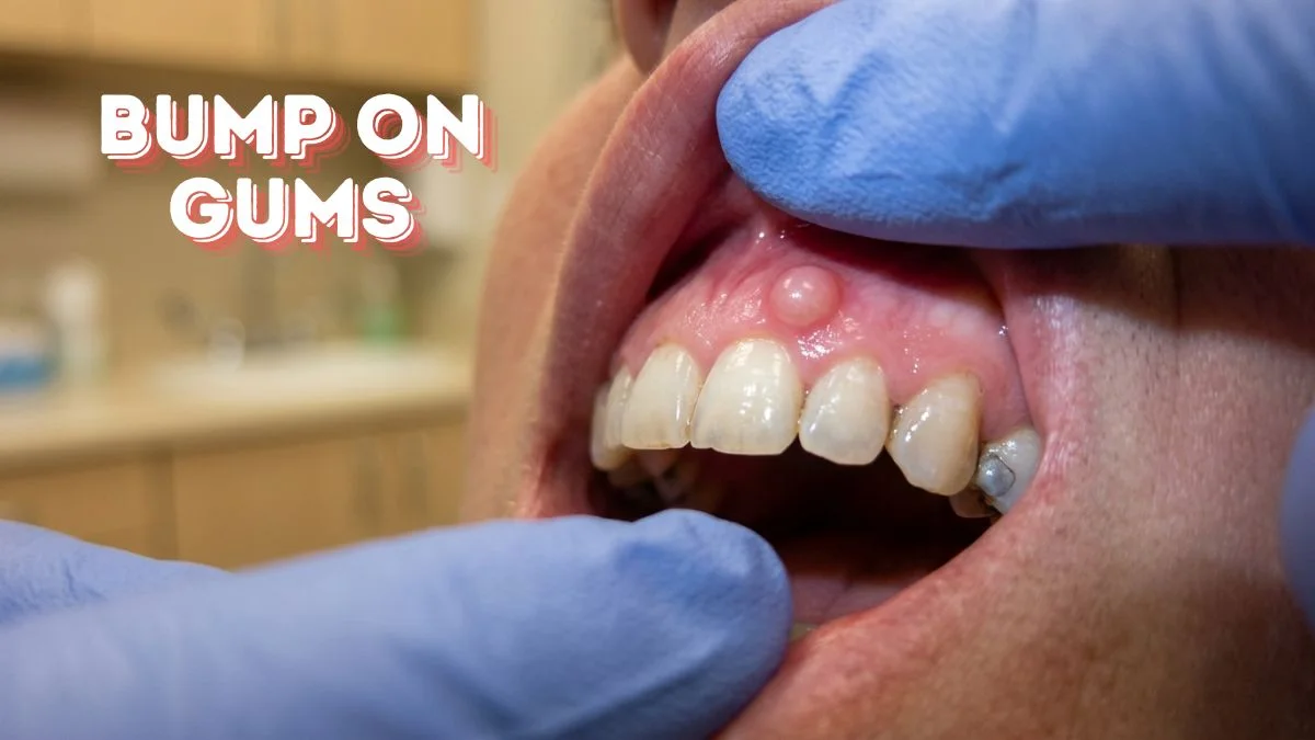 bump on gums