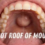 knot roof of mouth